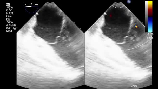 Ultrasound Transesophageal Examination Heart — Stock Video