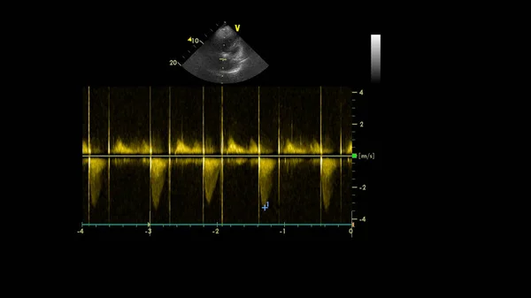 Изображение Сердца Сером Режиме Время Трансофагеального Ультразвука — стоковое фото