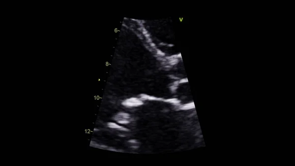 Image Heart Gray Scale Mode Transesophageal Ultrasound — Stock Photo, Image