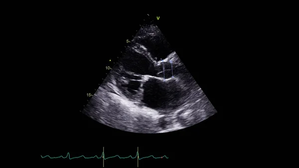 Изображение Сердца Сером Режиме Время Трансофагеального Ультразвука — стоковое фото