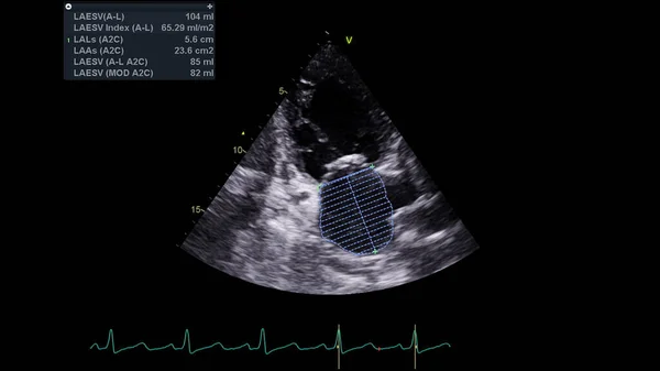 Transesofageal Ultrason Sırasında Kalbin Gri Ölçekli Görüntüsü — Stok fotoğraf