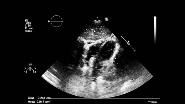 Obrázek Srdce Šedém Měřítku Během Transesofageálního Ultrazvuku — Stock fotografie