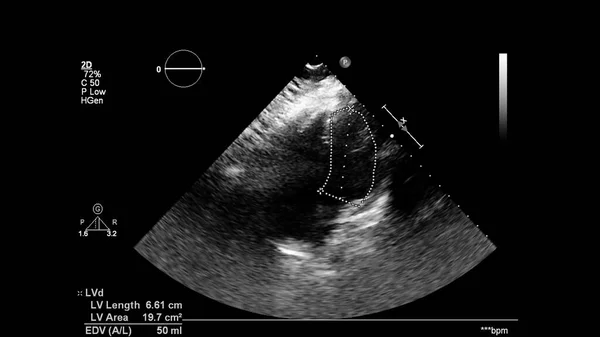 Afbeelding Van Het Hart Grijs Schaal Modus Tijdens Transesofageale Echografie — Stockfoto