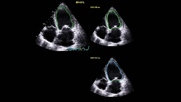 Image of the heart in gray-scale mode during transesophageal ultrasound.