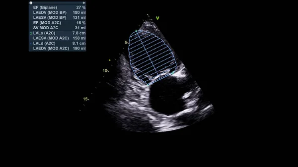 Image of the heart in gray-scale mode during transesophageal ultrasound.