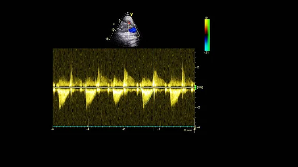 Transesofageal Ultrason Sırasında Doppler Kipi Ile Kalbin Görüntüsü — Stok fotoğraf