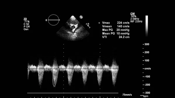 Image of the heart in gray-scale mode during transesophageal ultrasound.