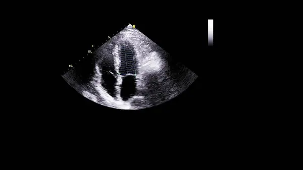 Image Heart Gray Scale Mode Transesophageal Ultrasound — Stock Photo, Image