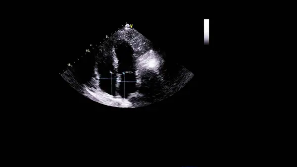 Image Heart Gray Scale Mode Transesophageal Ultrasound — Stock Photo, Image