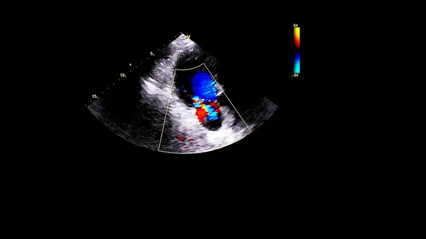 Image Heart Transesophageal Ultrasound Doppler Mode — Stock Photo, Image