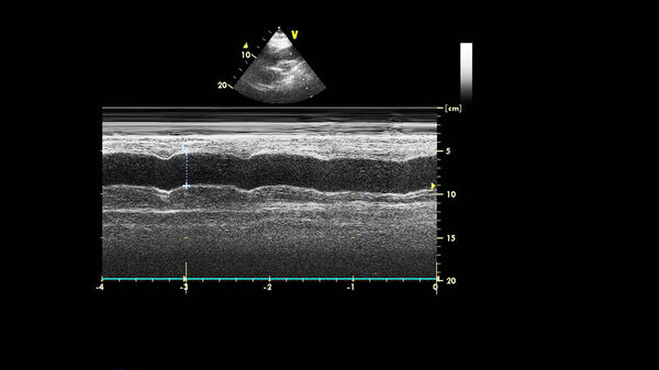 Изображение сердца в сером режиме во время трансофагеального ультразвука.