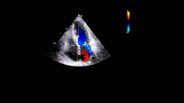 Imagen Del Corazón Durante Ecografía Transesofágica Con Modo Doppler — Foto de Stock