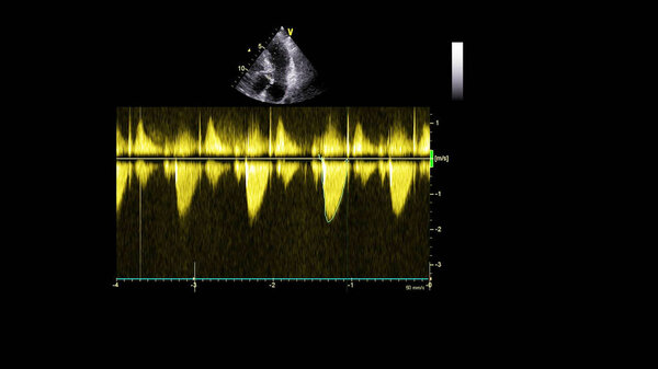 Изображение сердца в сером режиме во время трансофагеального ультразвука.