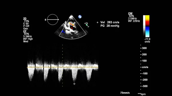 Imagen Del Corazón Durante Ecografía Transesofágica Con Modo Doppler — Foto de Stock