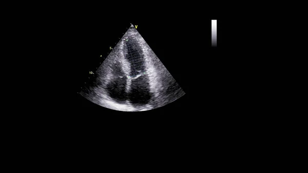 Afbeelding Van Het Hart Grijs Schaal Modus Tijdens Transesofageale Echografie — Stockfoto