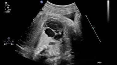 Transesofageal ultrason sırasında kalbin görüntüsü..