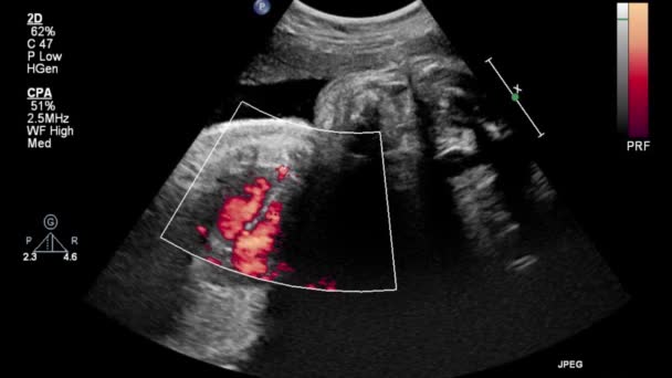 Image Heart Transesophageal Ultrasound — 비디오