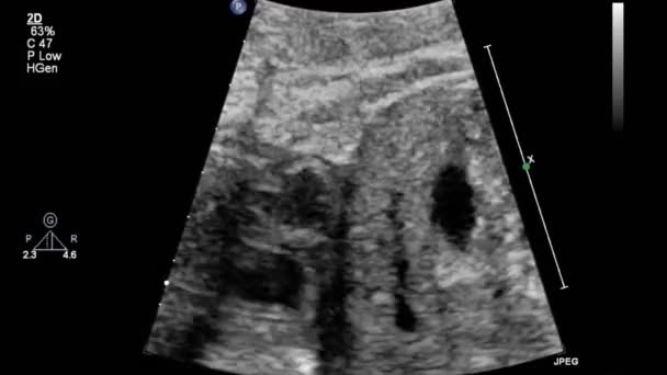 経食道超音波検査中の心臓の画像 — ストック動画