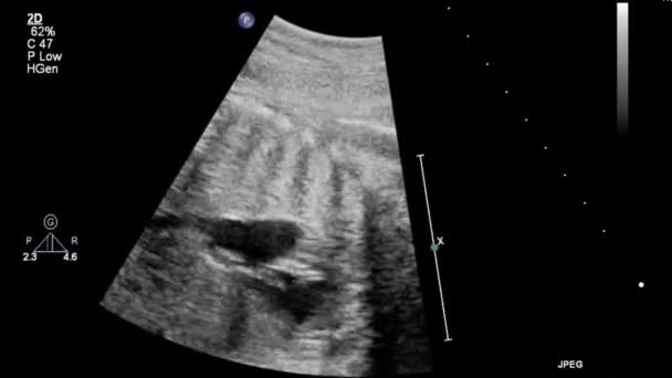 Beeld Van Het Hart Tijdens Transesofageale Echografie — Stockvideo