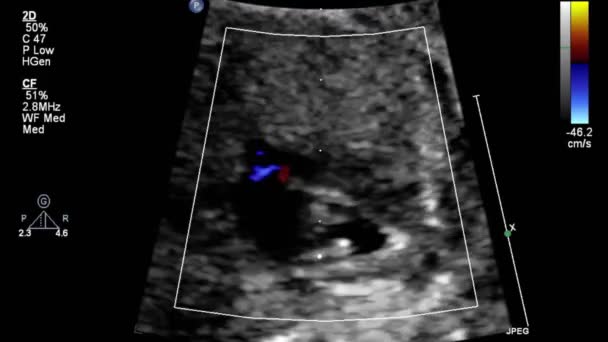 Image Heart Transesophageal Ultrasound — Stock Video