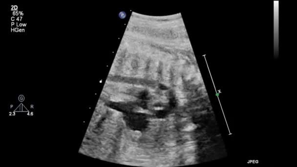 Image Heart Transesophageal Ultrasound — 비디오