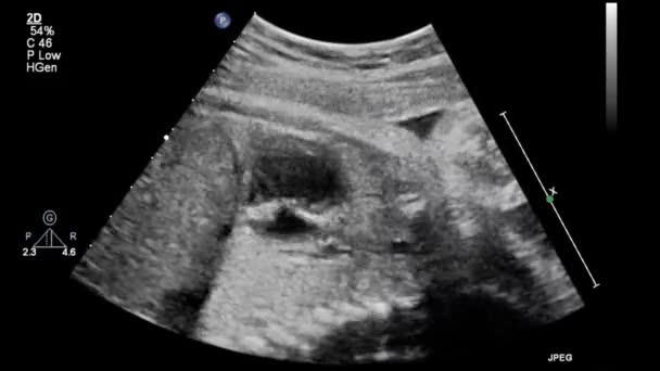 Imagem Coração Durante Ultrassonografia Transesofágica — Vídeo de Stock