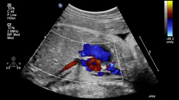 Transesofageal Ultrason Sırasında Kalbin Görüntüsü — Stok video