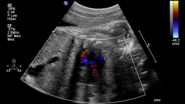 Image Heart Transesophageal Ultrasound — Stock Video