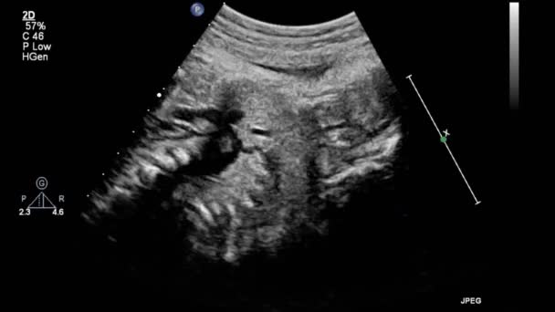 Bild Des Herzens Beim Transesophagealen Ultraschall — Stockvideo