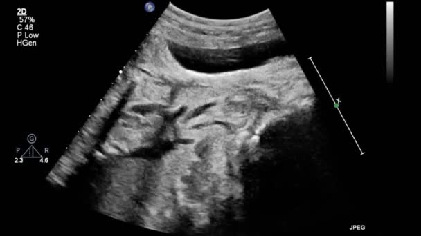 Image Heart Transesophageal Ultrasound — Stock Video