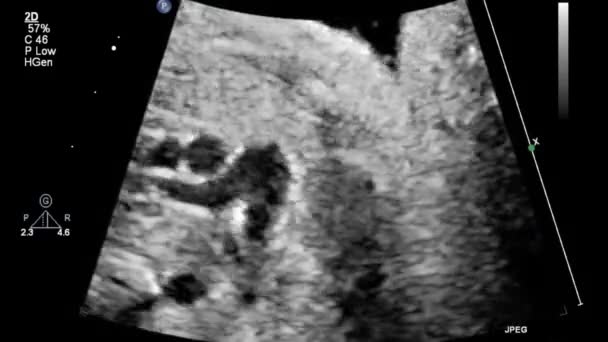 Image Heart Transesophageal Ultrasound — Stock Video