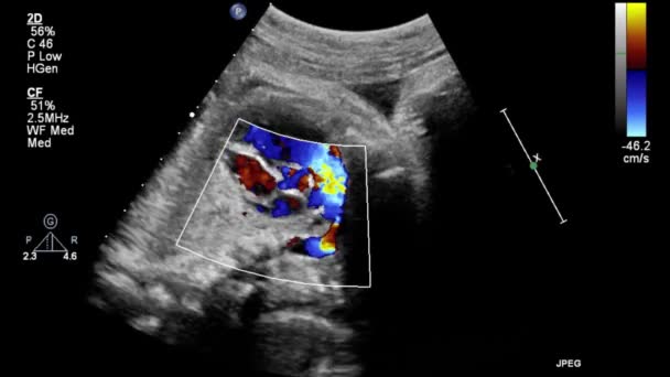 Изображение Сердца Время Трансофагеального Узи — стоковое видео