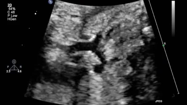 Image Heart Transesophageal Ultrasound — 비디오