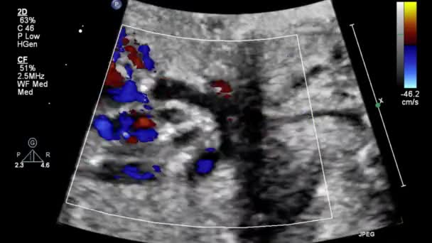 Image Heart Transesophageal Ultrasound — Stock Video