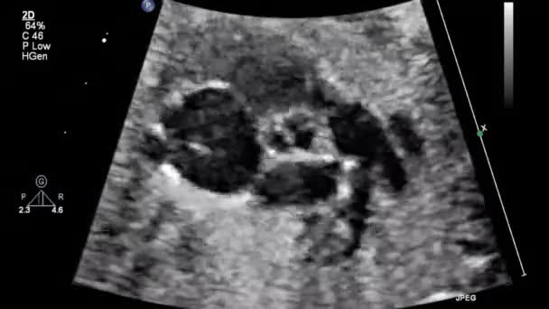 Image Heart Transesophageal Ultrasound — Stock Video