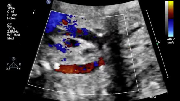 Image Heart Transesophageal Ultrasound — Stock Video