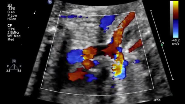 Imagem Coração Durante Ultrassonografia Transesofágica — Vídeo de Stock