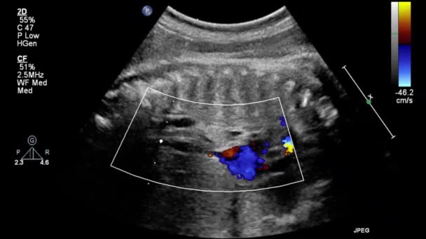 Image Heart Transesophageal Ultrasound — 비디오