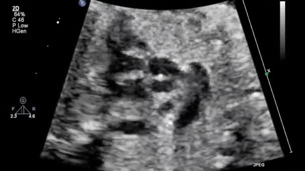 Image Heart Transesophageal Ultrasound — 비디오