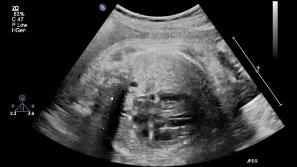 Bild Des Herzens Beim Transesophagealen Ultraschall — Stockvideo