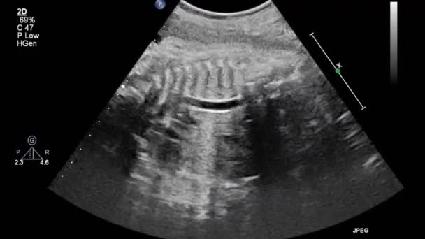 Image Heart Transesophageal Ultrasound — Stock Video