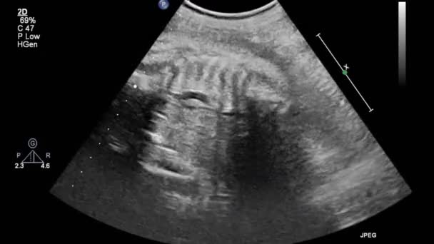 経食道超音波検査中の心臓の画像 — ストック動画