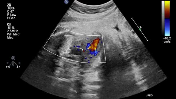 Beeld Van Het Hart Tijdens Transesofageale Echografie — Stockvideo