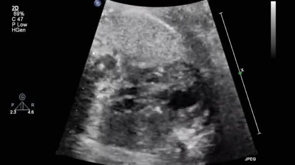 Transesofageal Ultrason Sırasında Kalbin Görüntüsü — Stok video