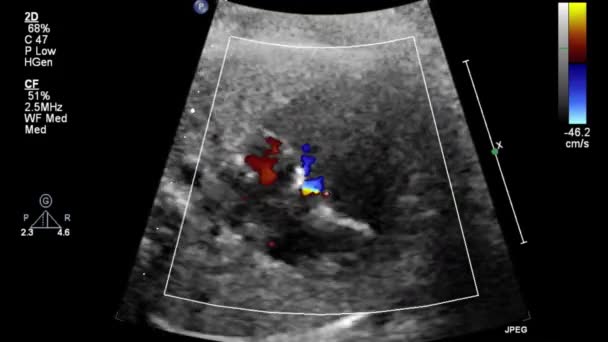 Image Heart Transesophageal Ultrasound — Stock Video