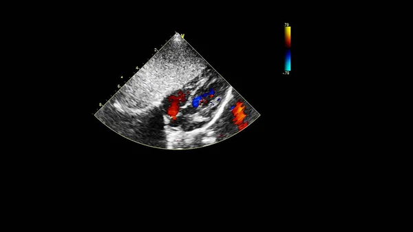 Bild Des Herzens Beim Transesophagealen Ultraschall Mit Doppler Modus — Stockfoto