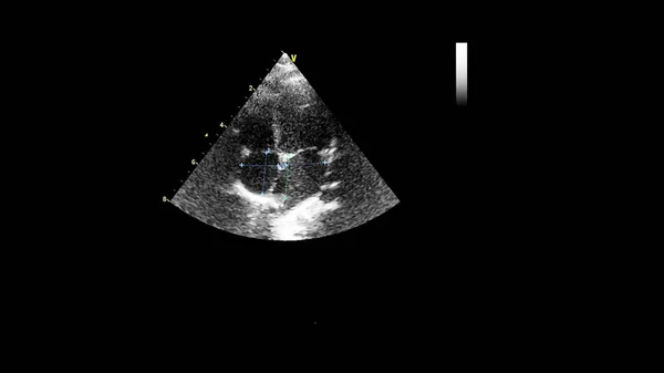 Afbeelding Van Het Hart Grijs Schaal Modus Tijdens Transesofageale Echografie — Stockfoto