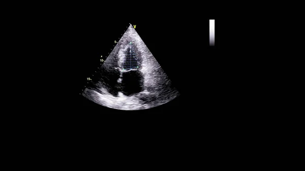 Image Heart Gray Scale Mode Transesophageal Ultrasound — Stock Photo, Image