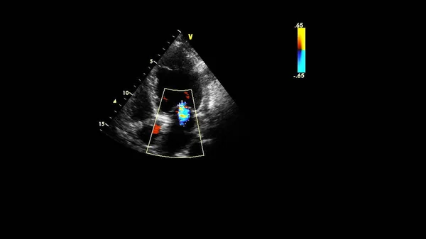 Imagem Coração Durante Ultrassom Transesofágico Com Modo Doppler — Fotografia de Stock