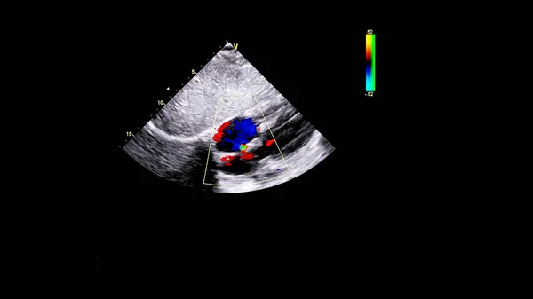 Bild Des Herzens Beim Transesophagealen Ultraschall Mit Doppler Modus — Stockfoto